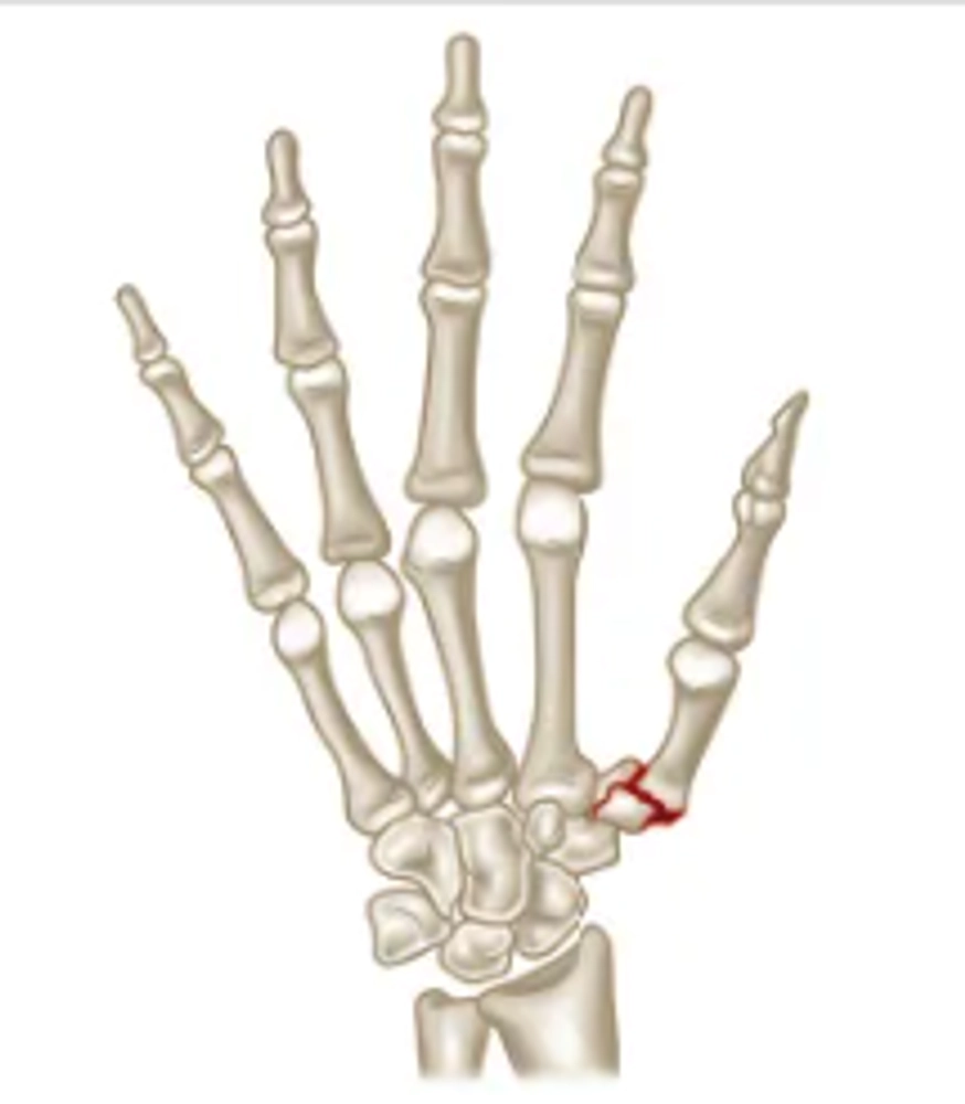 Comprehensive Guide to Understanding Rolando's Fracture