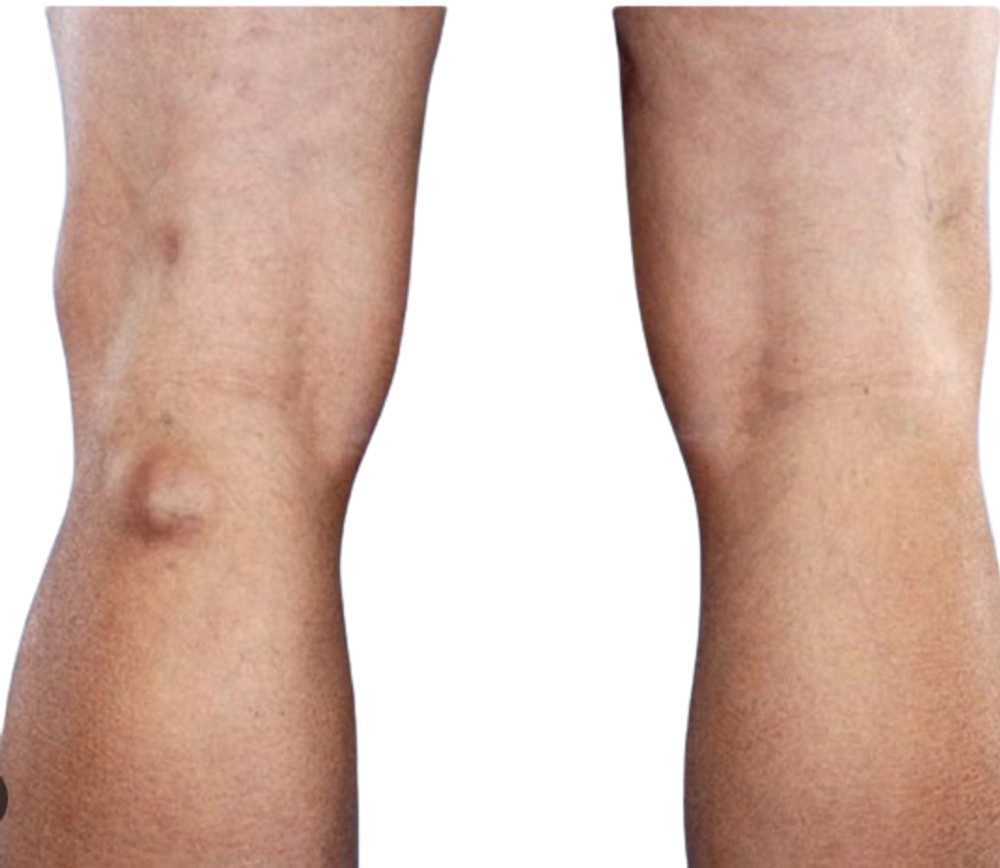 Comprehensive Guide to Understanding Popliteal Cyst