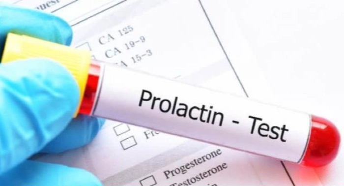 Prolactin Test (PRL)