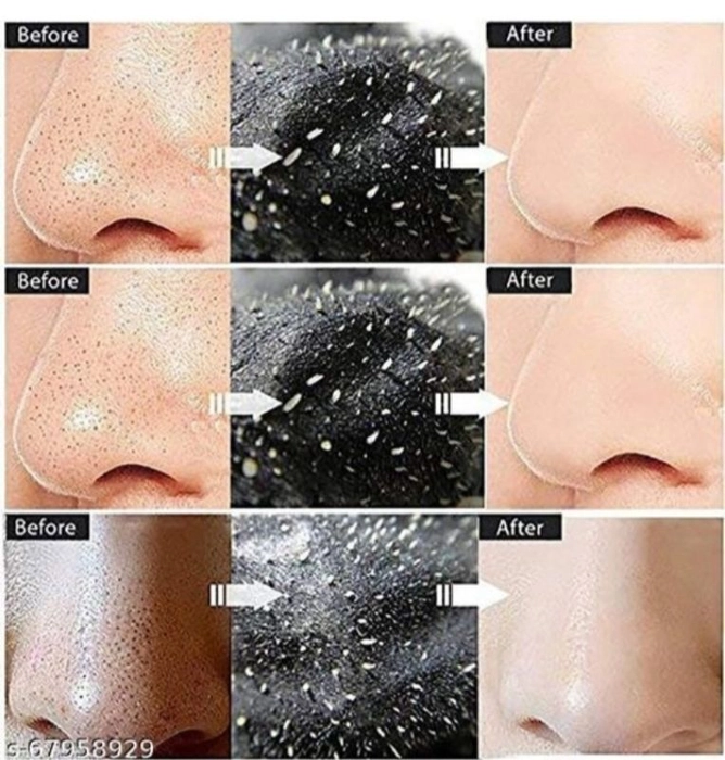 Charcoal Face Mask For Face (Blackheads -Whiteheads Remover)