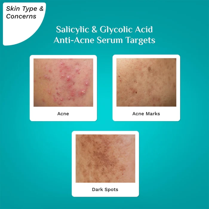 Salicylic & Glycolic Acid ANTI-ACNE SERUM