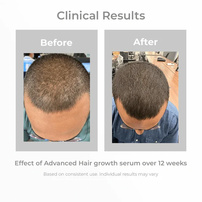 3% Redensyl + 4% Anagain Hair Growth Serum