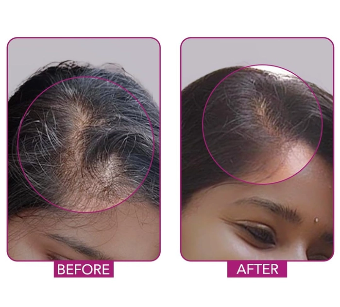 FOLILOCK ADVANCE HAIR SERUM FOR HAIR REGROWTH FOR MALE & FEMALE- 60ML