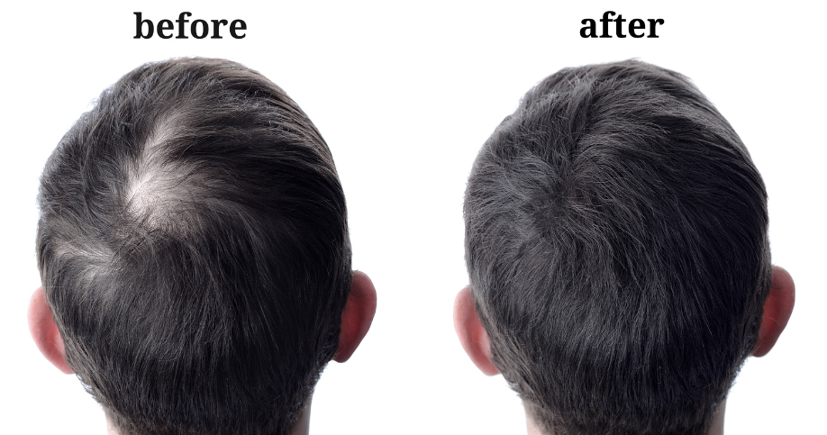 Male Hair growth Before and After